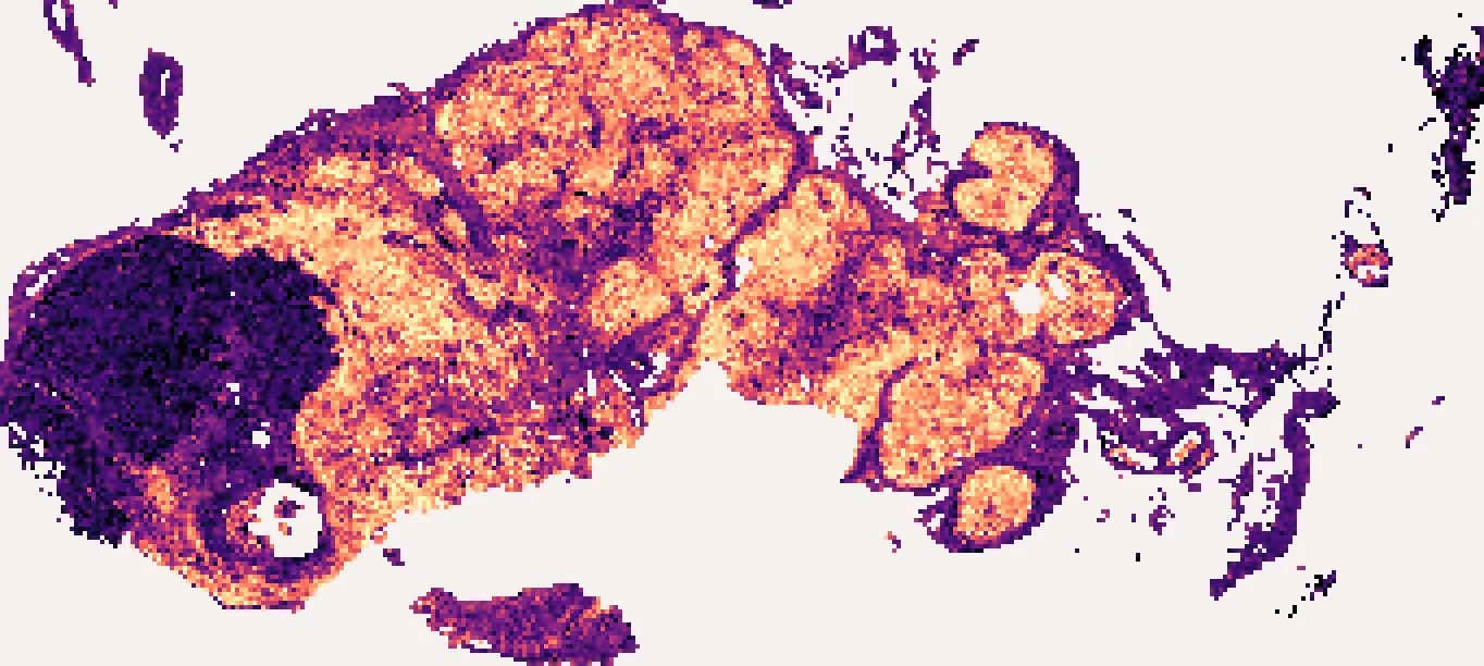 PTPRC predicted at every retained tile of the section: bright across the node's lymphoid tissue, with a large dark mass on the left where the deposit sits.