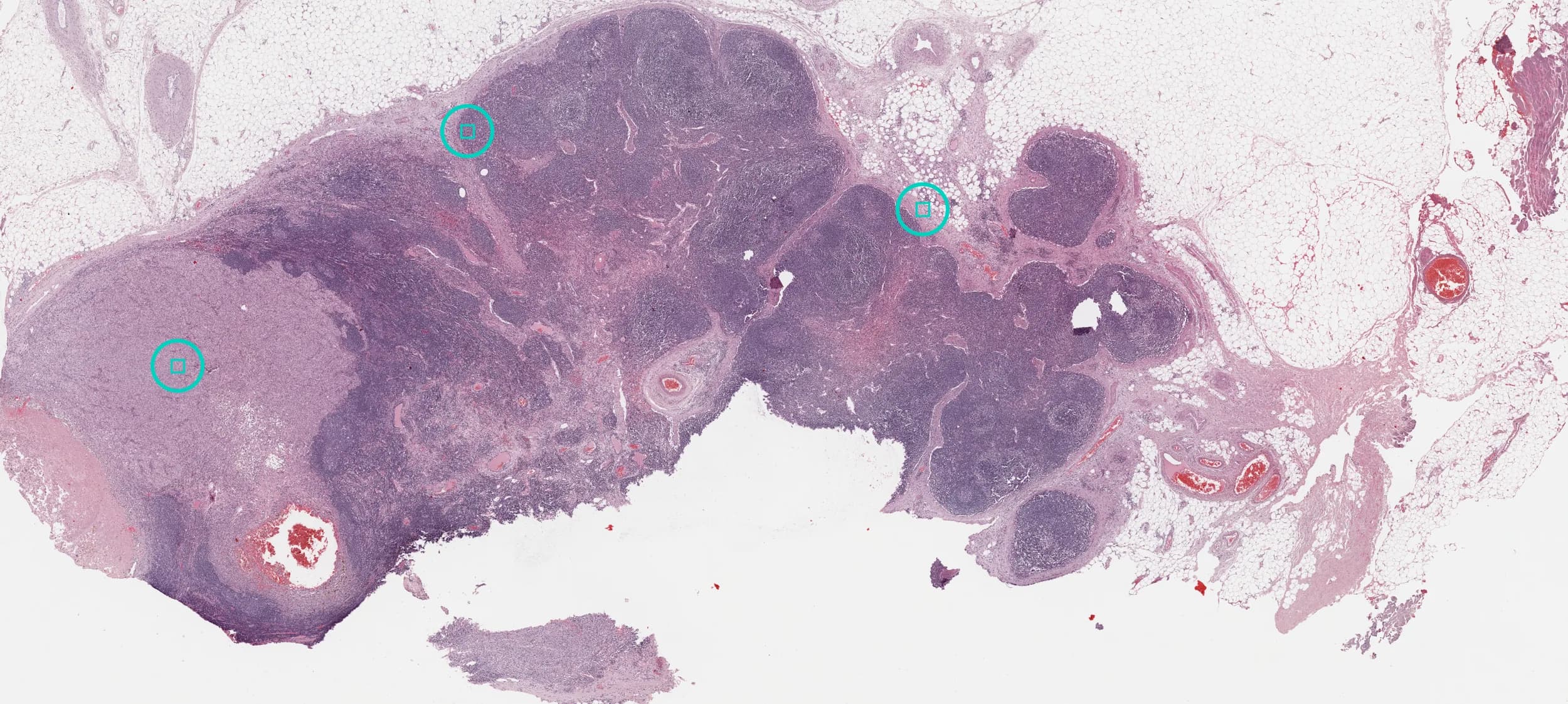 A melanoma metastasis in a lymph node at low magnification, stained pink and purple on the pale mount around it, with three rings marking places shown close up below.
