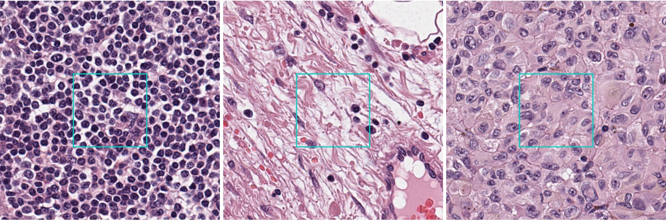 Three squares of the same slide at full resolution: lymphoid tissue, the collagen of the capsule and septa, and the deposit that replaced part of the node.